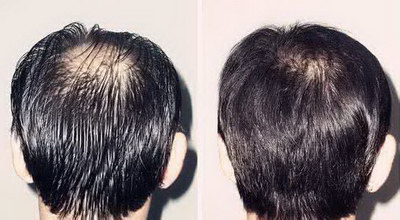 头皮油脂多导致脱发怎么办