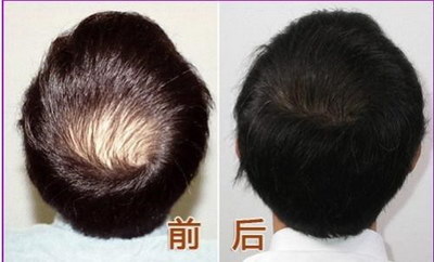 如何有效增加头发量？头发少者必看的护发技巧