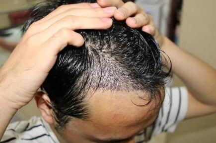 植发：头皮烫伤可以恢复新发质？
